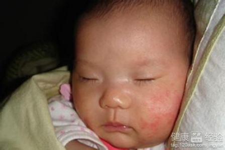 嬰兒濕疹如何治愈