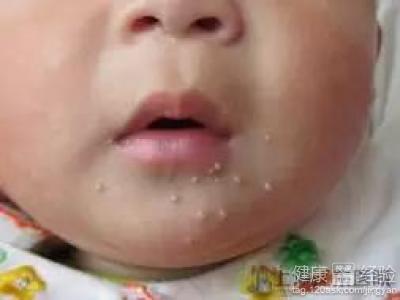 寶寶臉上的濕疹怎麼治療沒有刺激