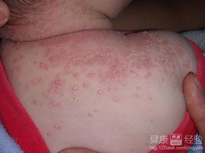 濕疹的有些什麼危害