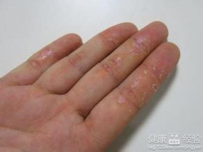 濕疹有什麼症狀怎麼治療？