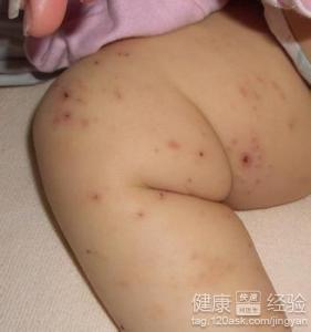 怎樣預防小兒濕疹的發生