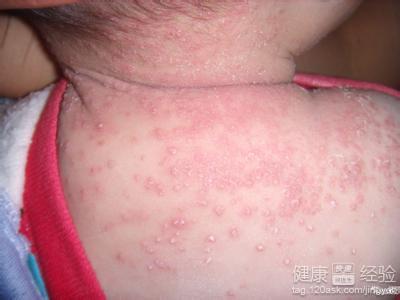 如何預防濕疹的發生？