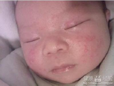 寶寶濕疹預防辦法
