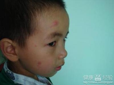 小孩子臉上濕疹怎麼辦
