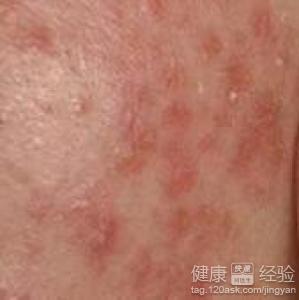 皮膚出現濕疹怎麼處理