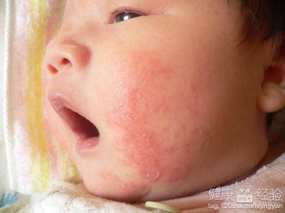 嬰兒濕疹是哪些原因引起的?