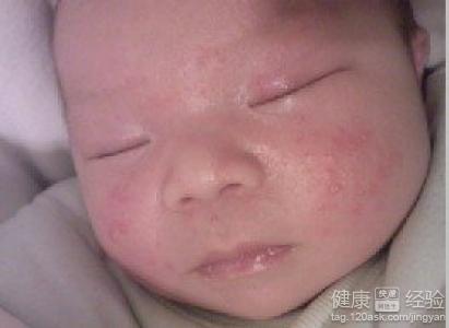 嬰兒濕疹主要有哪些原因引起的呢？
