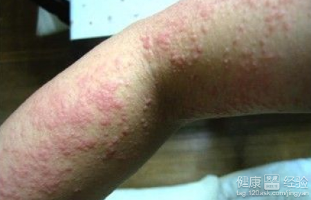 濕疹要怎麼預防呢？