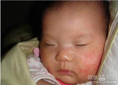 嬰兒長濕疹怎麼辦？