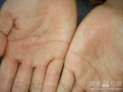 干燥性手部濕疹如何防治？