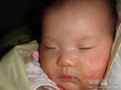 家長要小心尿布引起的嬰兒濕疹