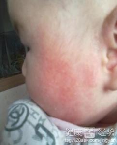 小兒濕疹該如何治療?
