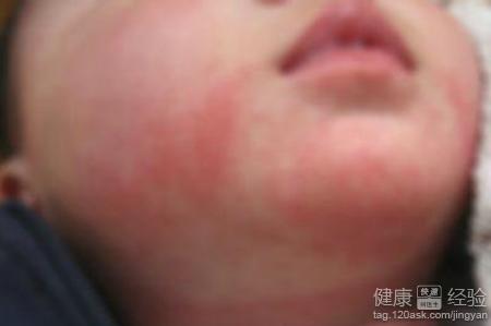 小寶寶得了濕疹怎麼辦？