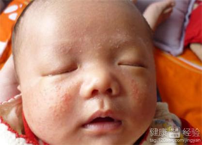 嬰兒濕疹飲食需要注意哪些