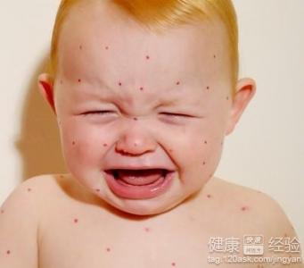 嬰幼兒如何防治濕疹