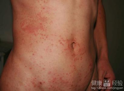 皮炎濕疹有哪些臨床症狀？