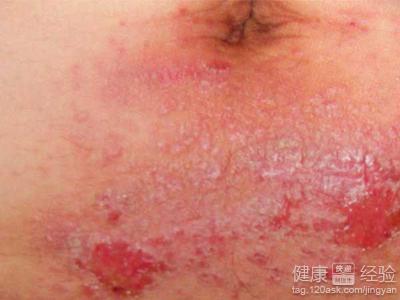 皮膚患上濕疹要怎麼治療？