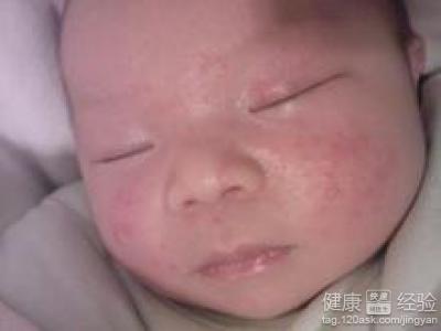 寶寶濕疹該如何治療啊？