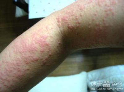 濕疹該怎麼預防？