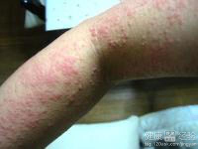 手上長了濕疹怎麼辦，該怎麼治療呢？