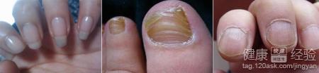 手足癬染上灰指甲要如何治療
