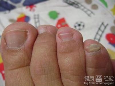 灰指甲和手足癬有什麼關聯