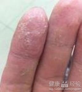 手足癬擦什麼藥效果最好