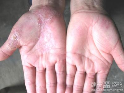 水泡型的手足癬傳染嗎怎麼根治