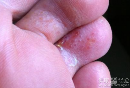 腳氣怎樣治療?