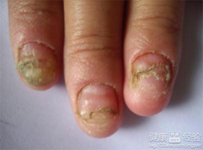 灰指甲如何治療？