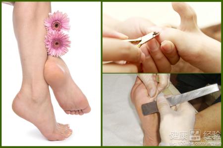 護理腳氣簡單有效的小妙招