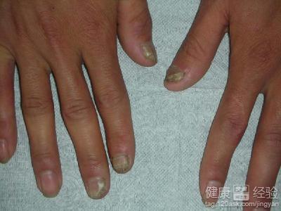 患上灰指甲怎麼治療呢？