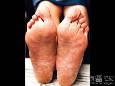 腳氣都是如何傳染上的