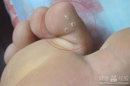 水泡型腳氣怎麼治療