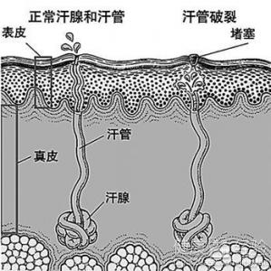 摩擦紅斑怎麼治療