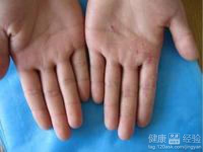 手足癬有哪些明顯症狀？