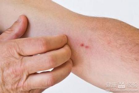中醫治療皮膚瘙癢症最好的方法是什麼啊