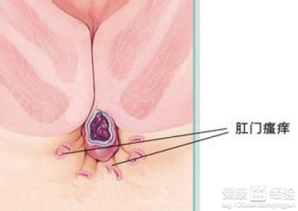 得了肛門瘙癢症怎麼治療