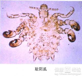 陰虱的最佳治療方法