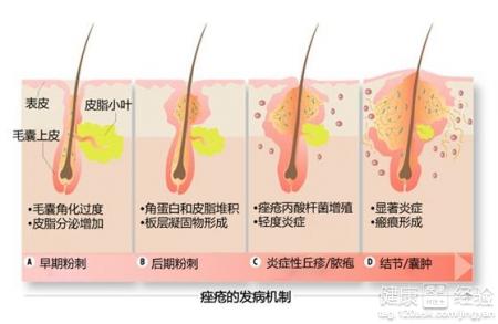 額頭總是起痘痘怎麼徹底擺脫這個問題