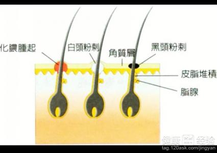 護膚小竅門之臉上長粉刺怎麼辦?茶葉面膜來幫忙