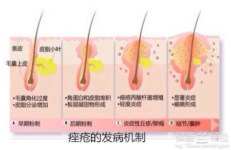 解秘痤瘡有哪些不同的類型