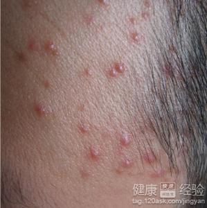 清潔皮膚預防粉刺痘痘再生