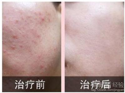 臉上長痤瘡怎麼辦怎樣護理