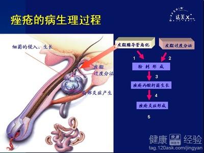 臉上長痤瘡怎麼辦