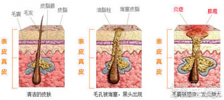 下巴長痘痘吃什麼中藥