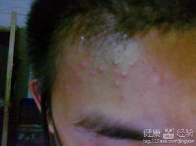 額頭老長痘痘怎麼辦