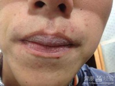 嘴周圍長痘痘是什麼原因