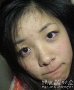 臉上長青春痘怎麼辦