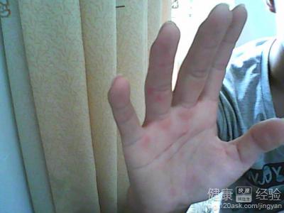 得了藥疹怎麼治療呢